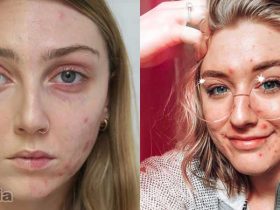 Filter Acne Instagram