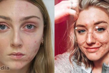 Filter Acne Instagram